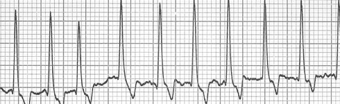 Electrocardiogram