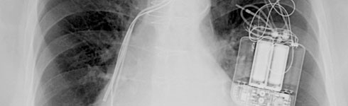 Cardiac-Pacemaker