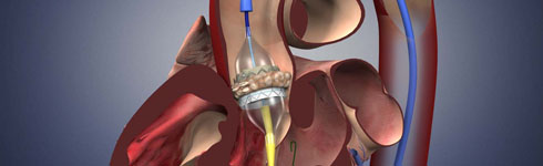 Heart-Valve-Replacement