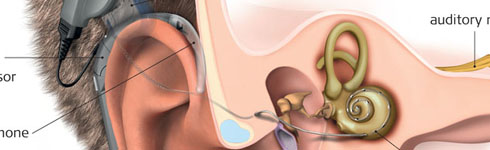 Cochlear-Implants